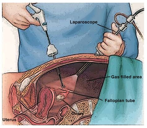 laparoscopic biopsy of ovary.